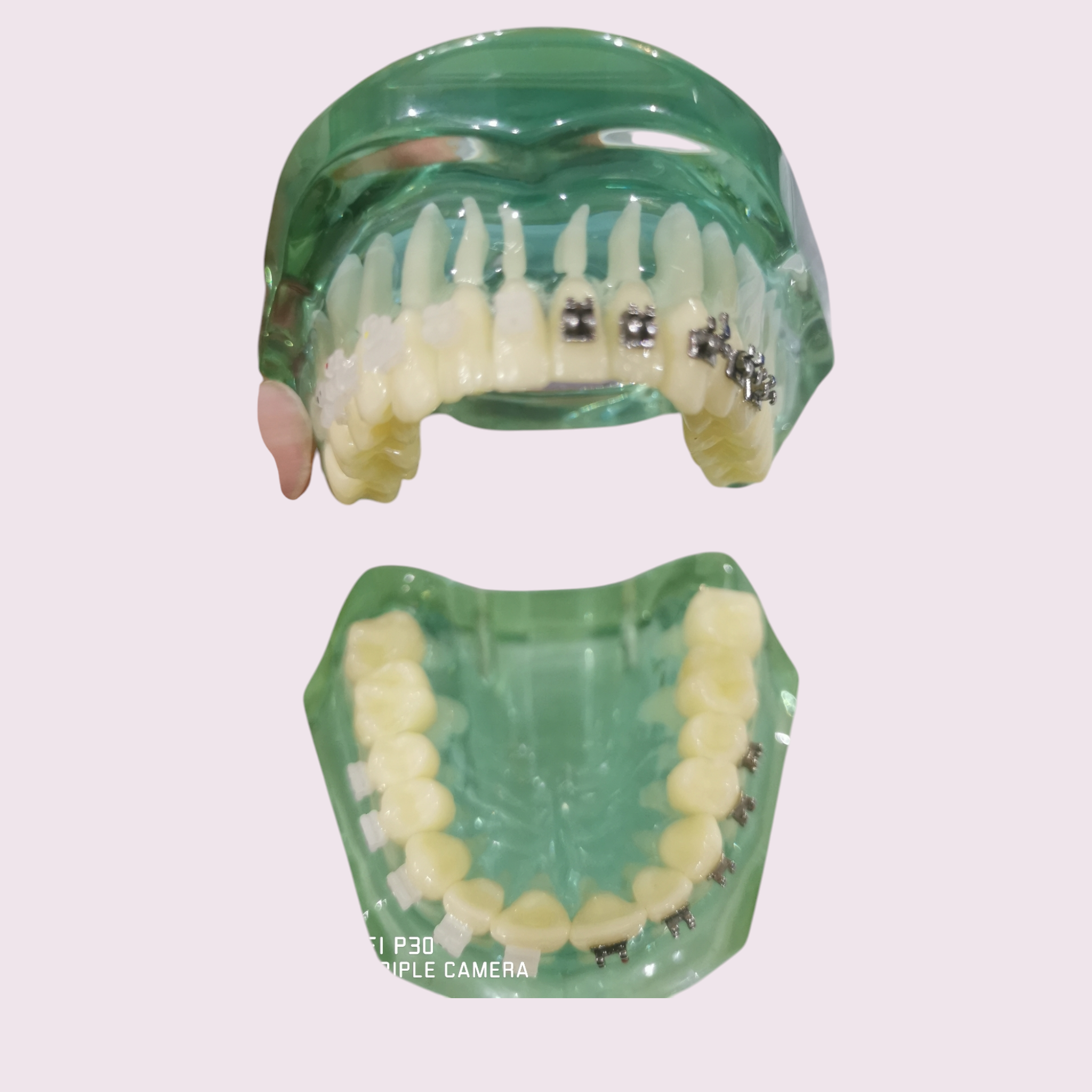 Typodont Orthodontics