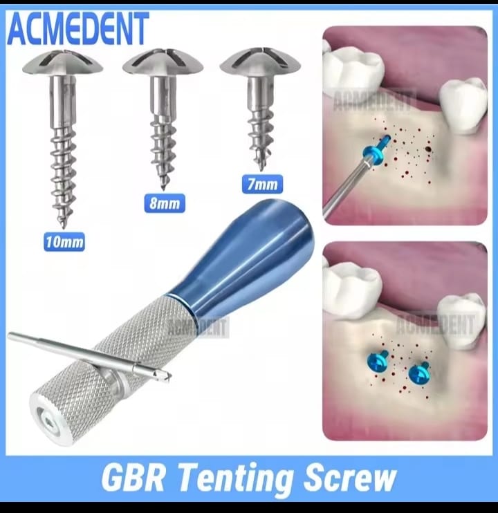 GBR dental implant kit whit 15 pes 