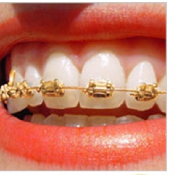 Metal braket Gold 